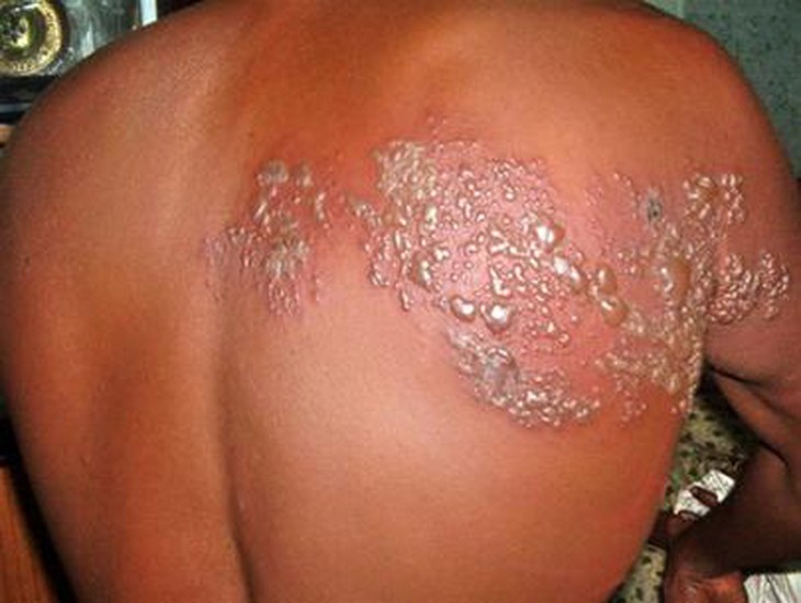 Những thuốc không được sử dụng trong bệnh “giời leo” 1